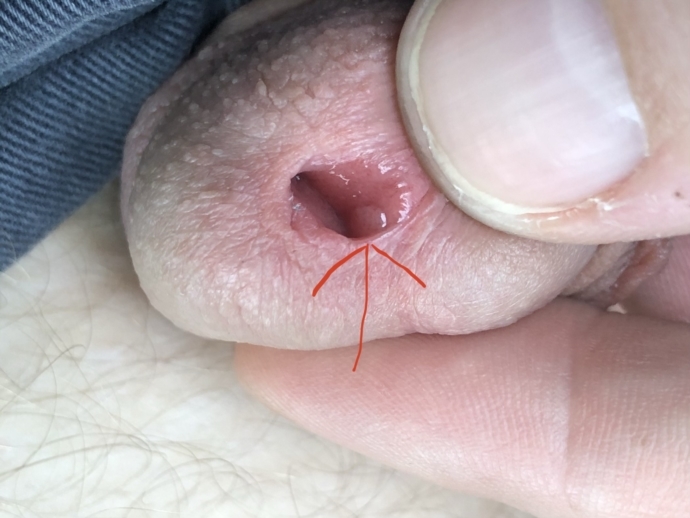 papiloame de negi pe vagin îndepărtarea verucilor genitale este periculoasă sau nu
