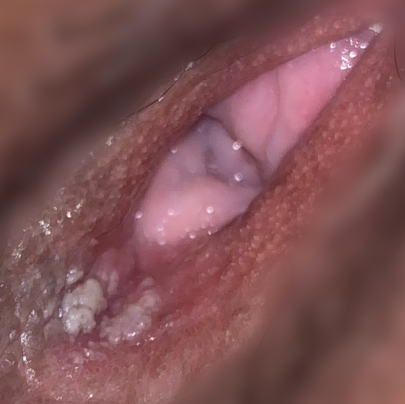 white spots inside vagina - nakednoyz.com.