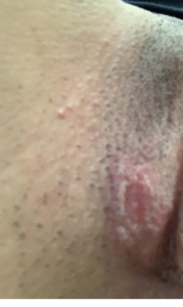 Bumps herpes razor Razor bumps