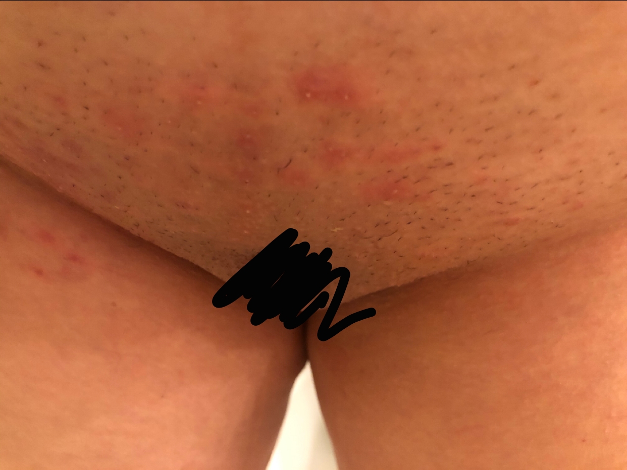Pubic area red after shaving