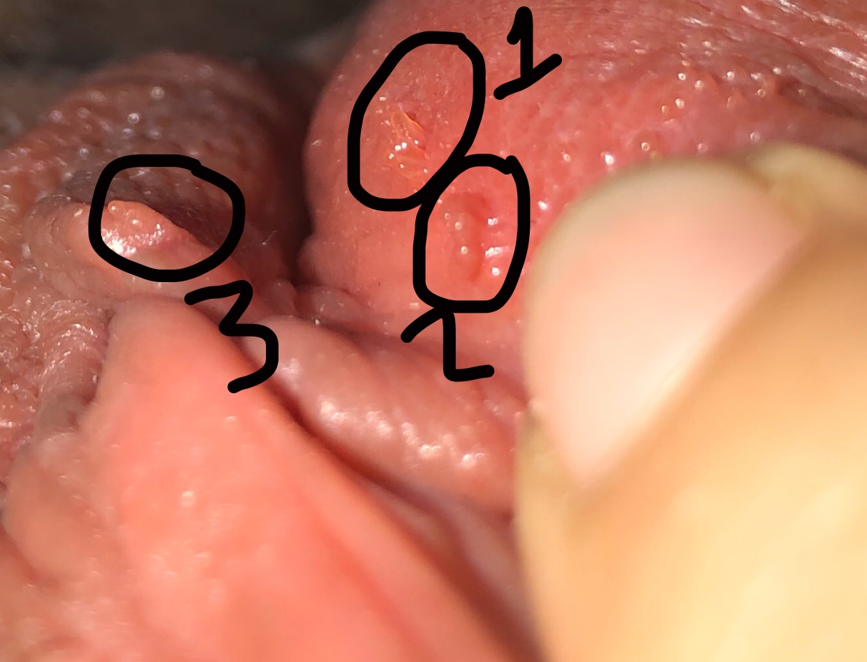 Vestibular papillomatosis and warts