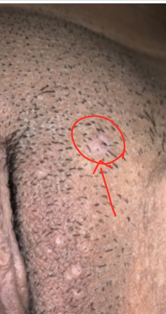 Can Warts Grow Hair Are These Genital Warts Help