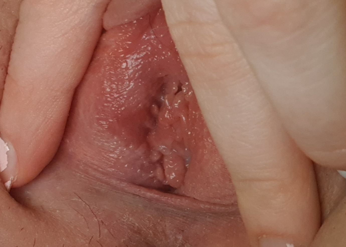 Swollen Vagina Or Vulva