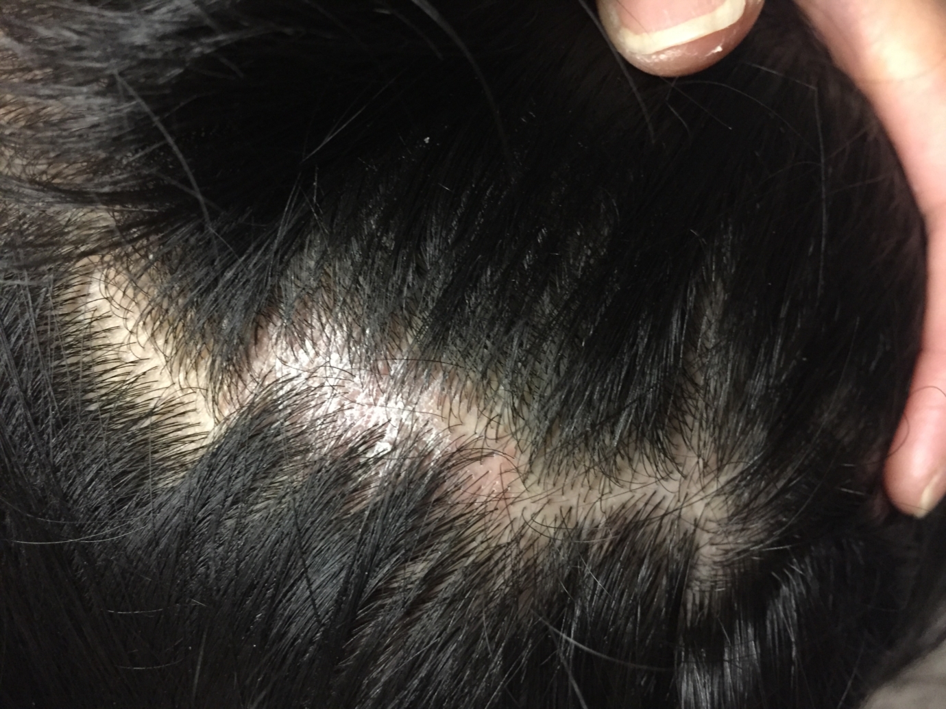 Scalp issue for almost a year | Dermatology | Forums | Patient