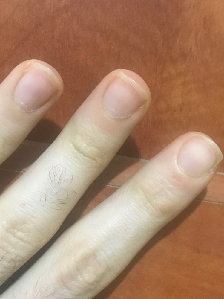 Unexplained symptoms- Terrys nails?B12 deficiency or something else? |  Other Conditions and General Health | Forums | Patient