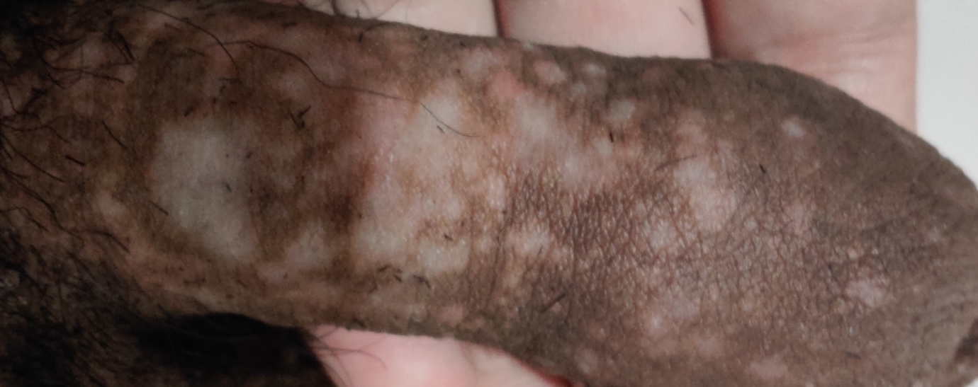 Cum să gestionați vitiligo penian