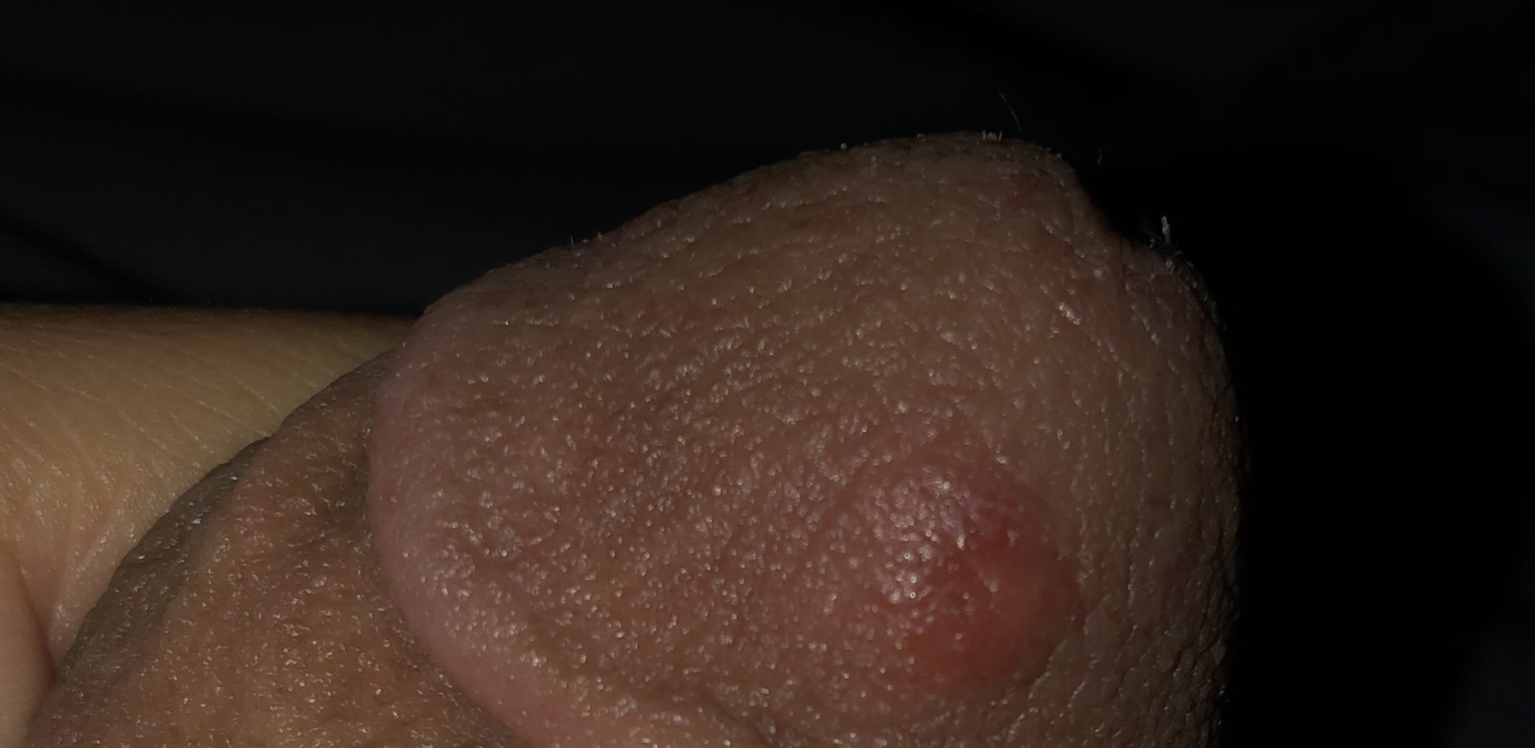 On scrotum bump red Bump on