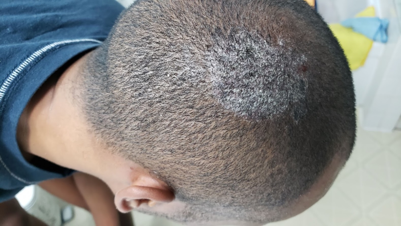 Itchy, Flaking, White Spots on Scalp | Dermatology | Forums | Patient