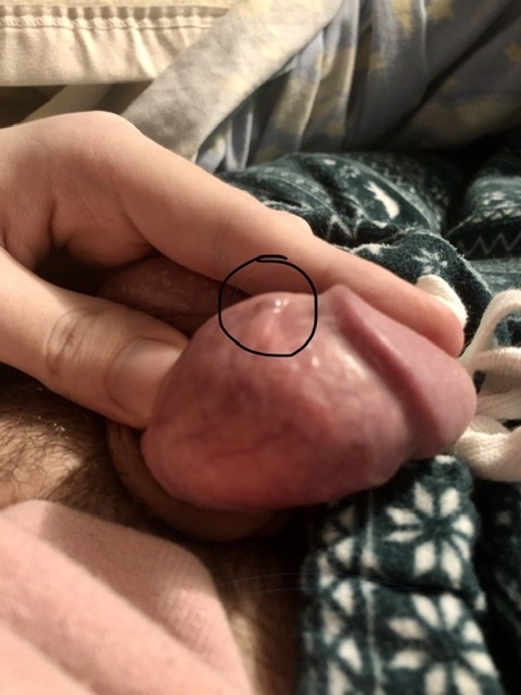 Frontier patient middelalderlig I have a small blue bump on my penis. | Penis Disorders | Forums | Patient