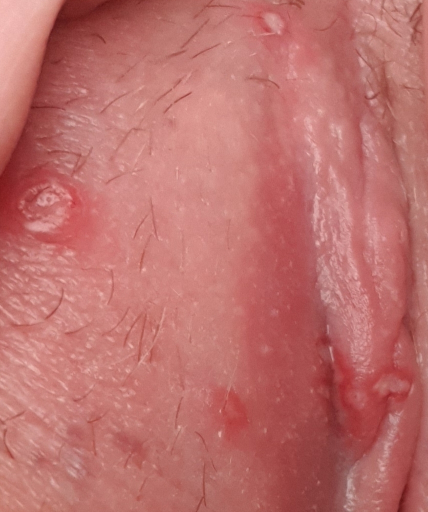 Vaginal Friction Burn