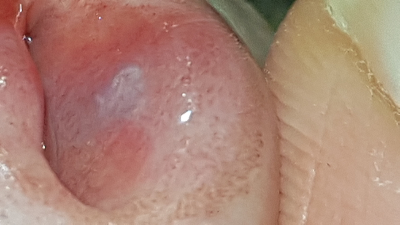 Unknown Infection of the Meatus | Penis Disorders Forums | Patient