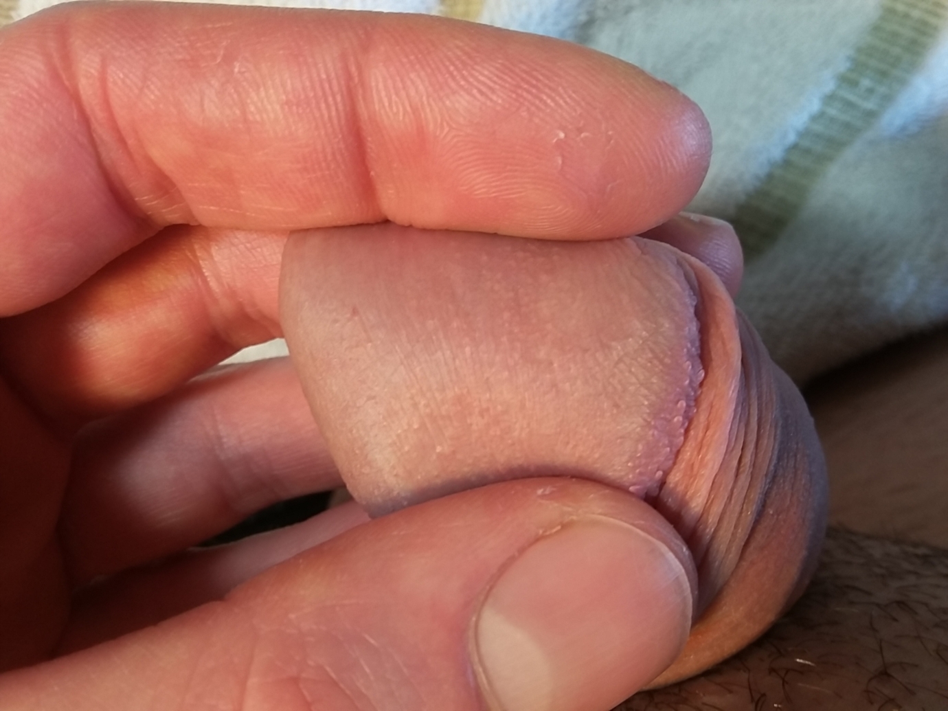 Small bumps on rim of penis