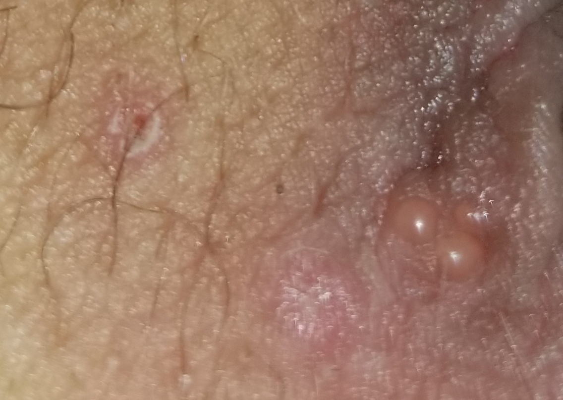 I Think I Have Herpes I M Worried Genital Herpes Simplex Forums Patient