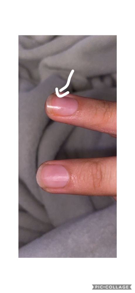White line | Nail Disorders | Forums | Patient
