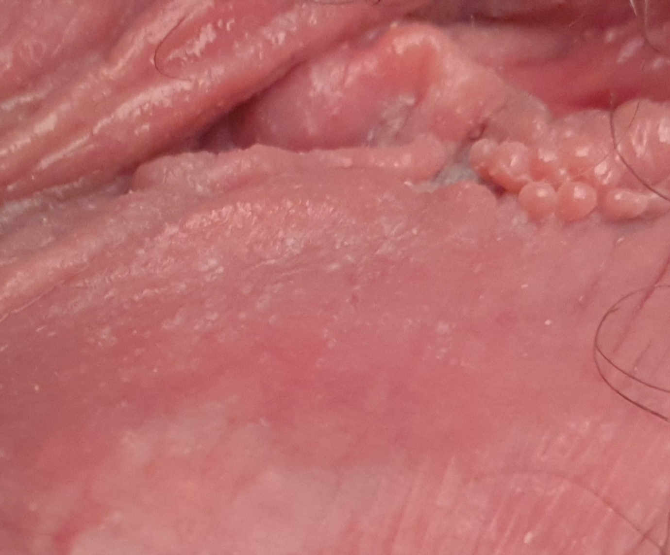 vestibular papillomatosis large îndepărtarea papilomelor în gură
