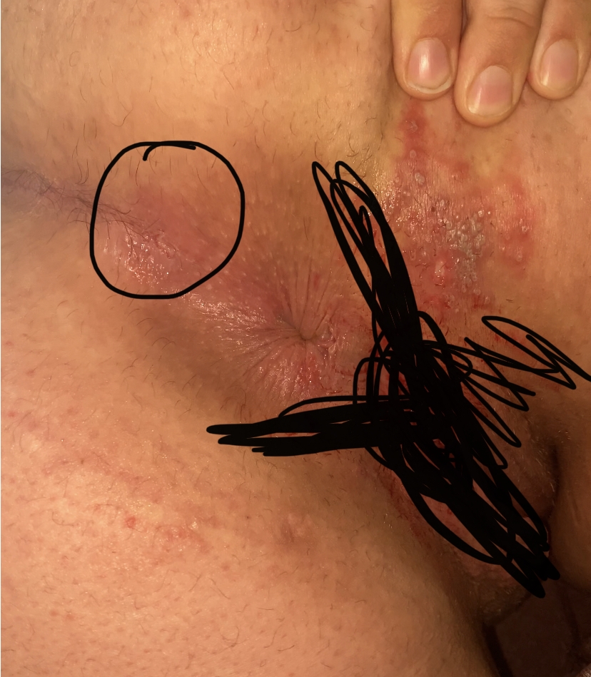 Vaginal Tearing During Childbirth