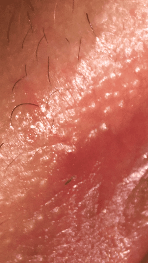 Herpes sore or a sore from shaving? RESPOND ASAP! | Genital Herpes