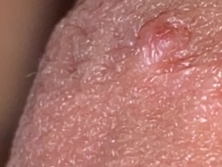 Pearly papules pink What is
