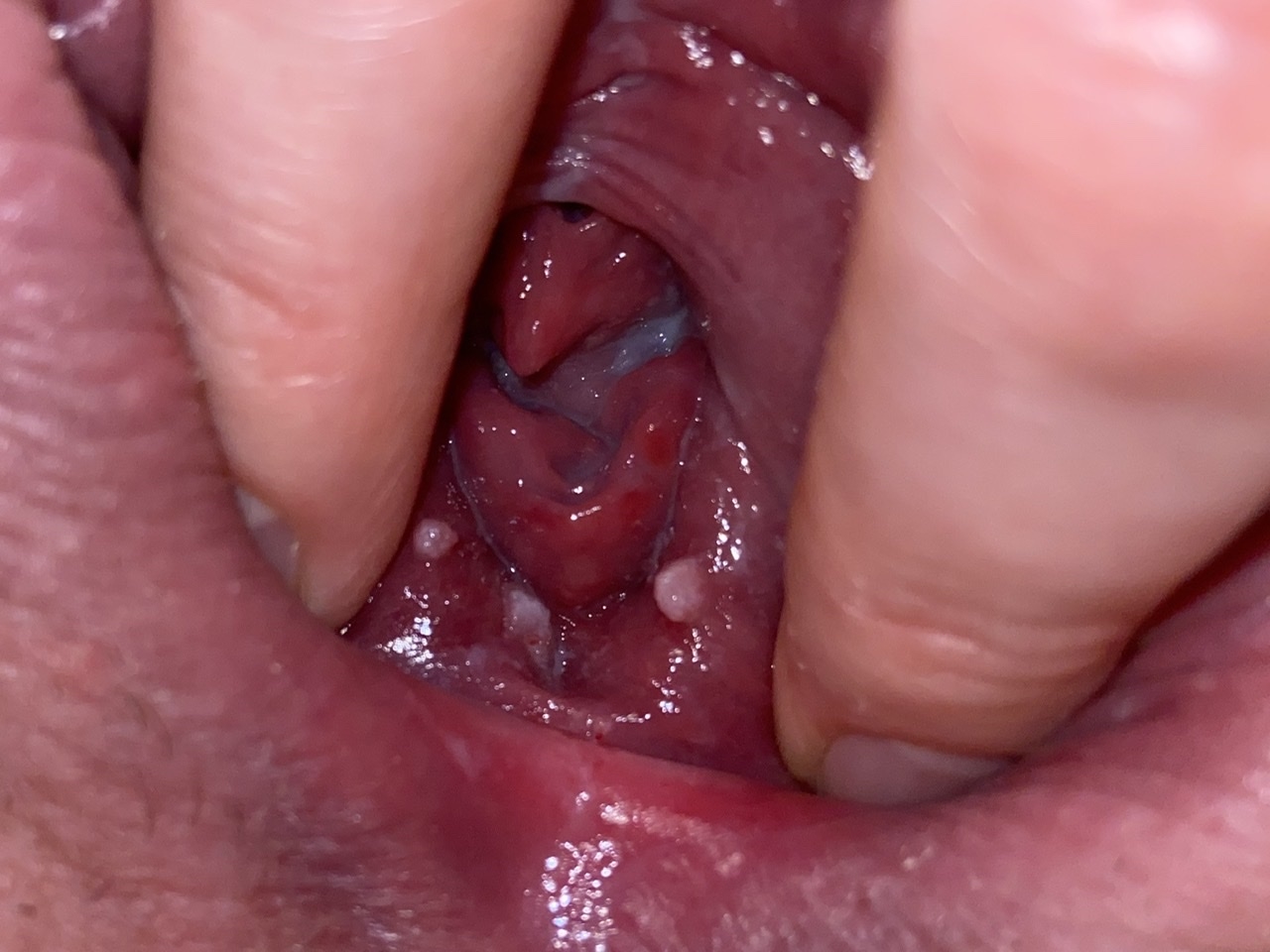hpv warts when pregnant