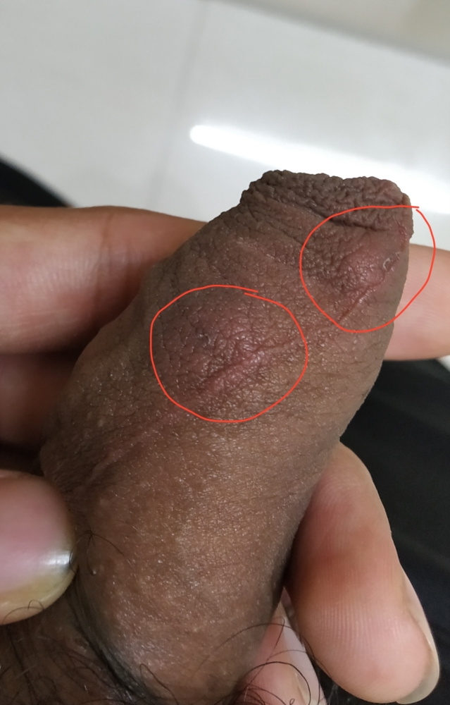 Un nodul solid la baza penisului - Nodul în penis ce este