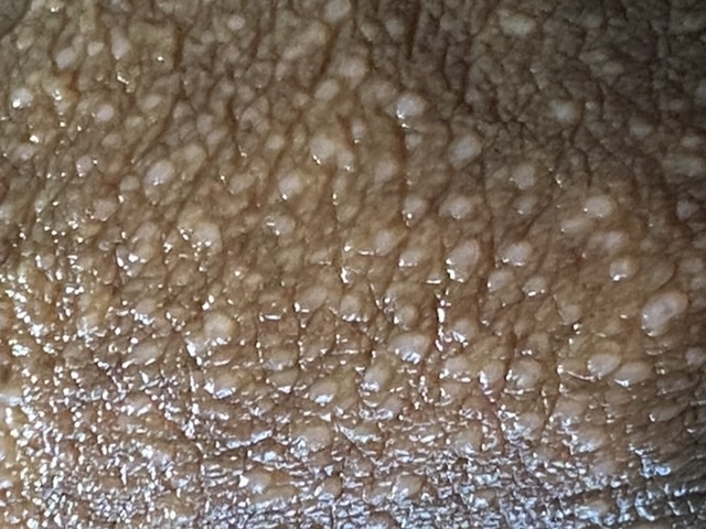 PLEASE HELP ROUGH BUMPY SKIN | Penis Disorders | Forums | Patient