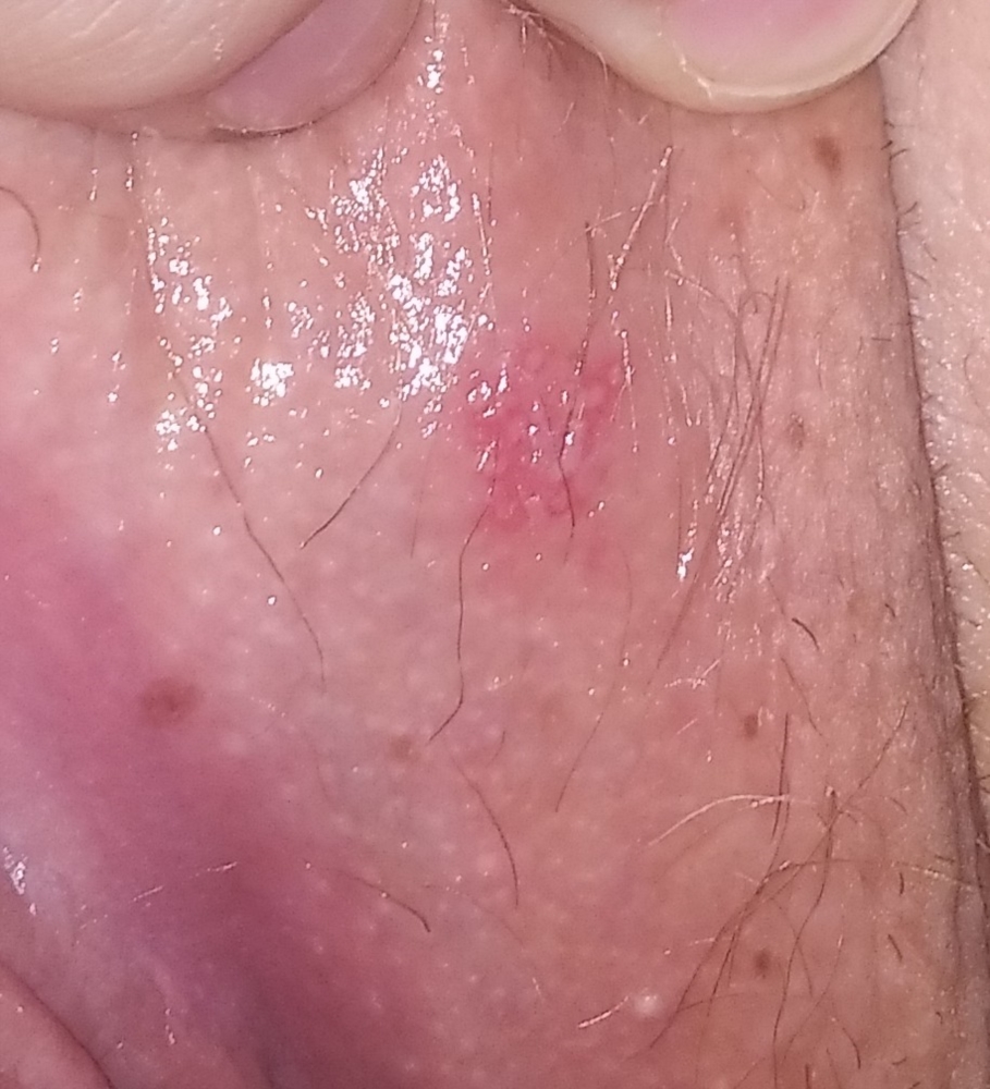 Help !!! Friction burn or herpes!! My anxiety is very high