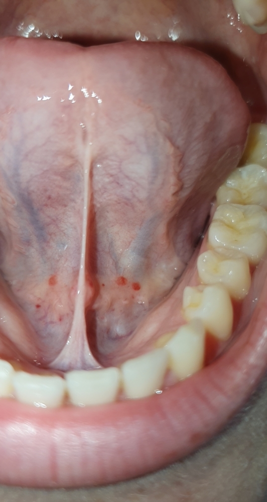 Sore Throat from Wisdom Teeth - Is it nonmal? After extraction