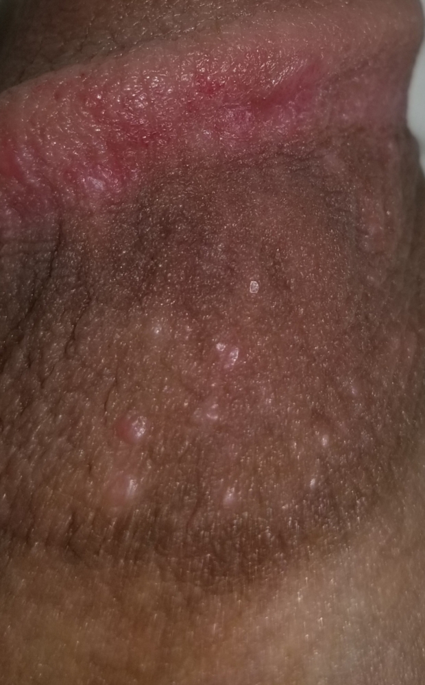 Red spots on penis after sex