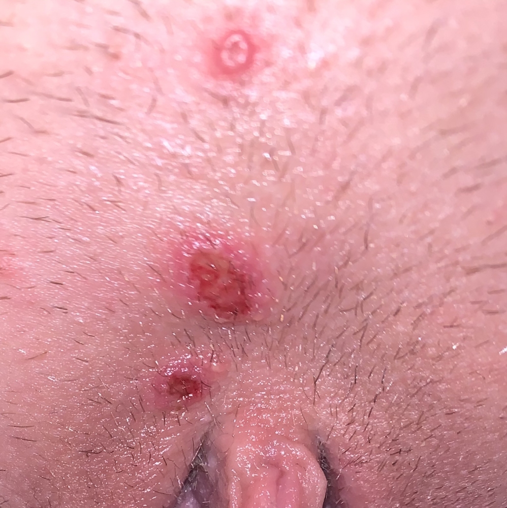 Is this herpes or infected ingrown hairs? Please help I'm freaking out!!!!  | Genital Herpes Simplex | Forums | Patient