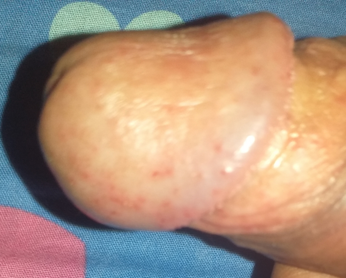 Spots of penis head red little on Bumps on