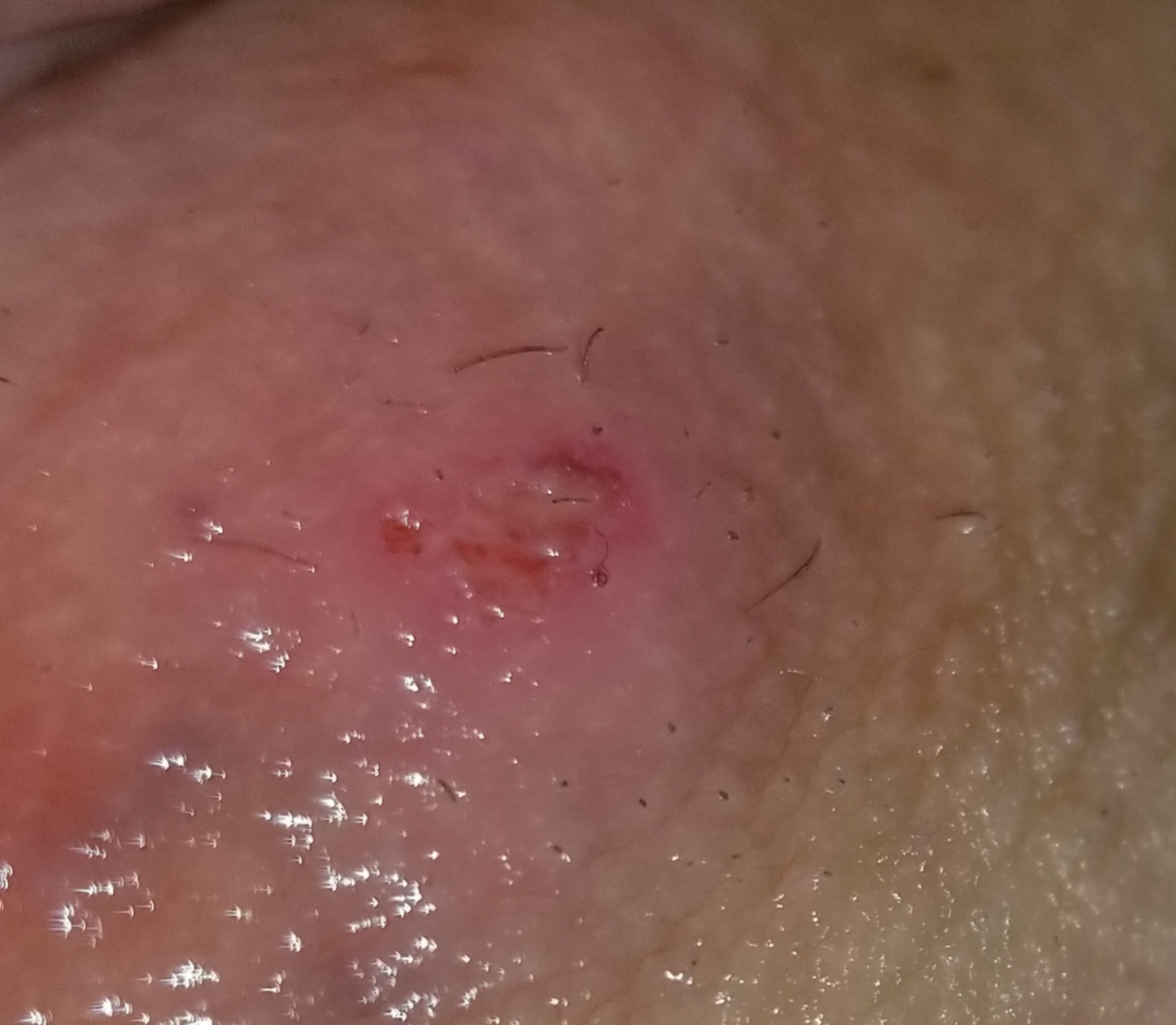 Bumps or herpes