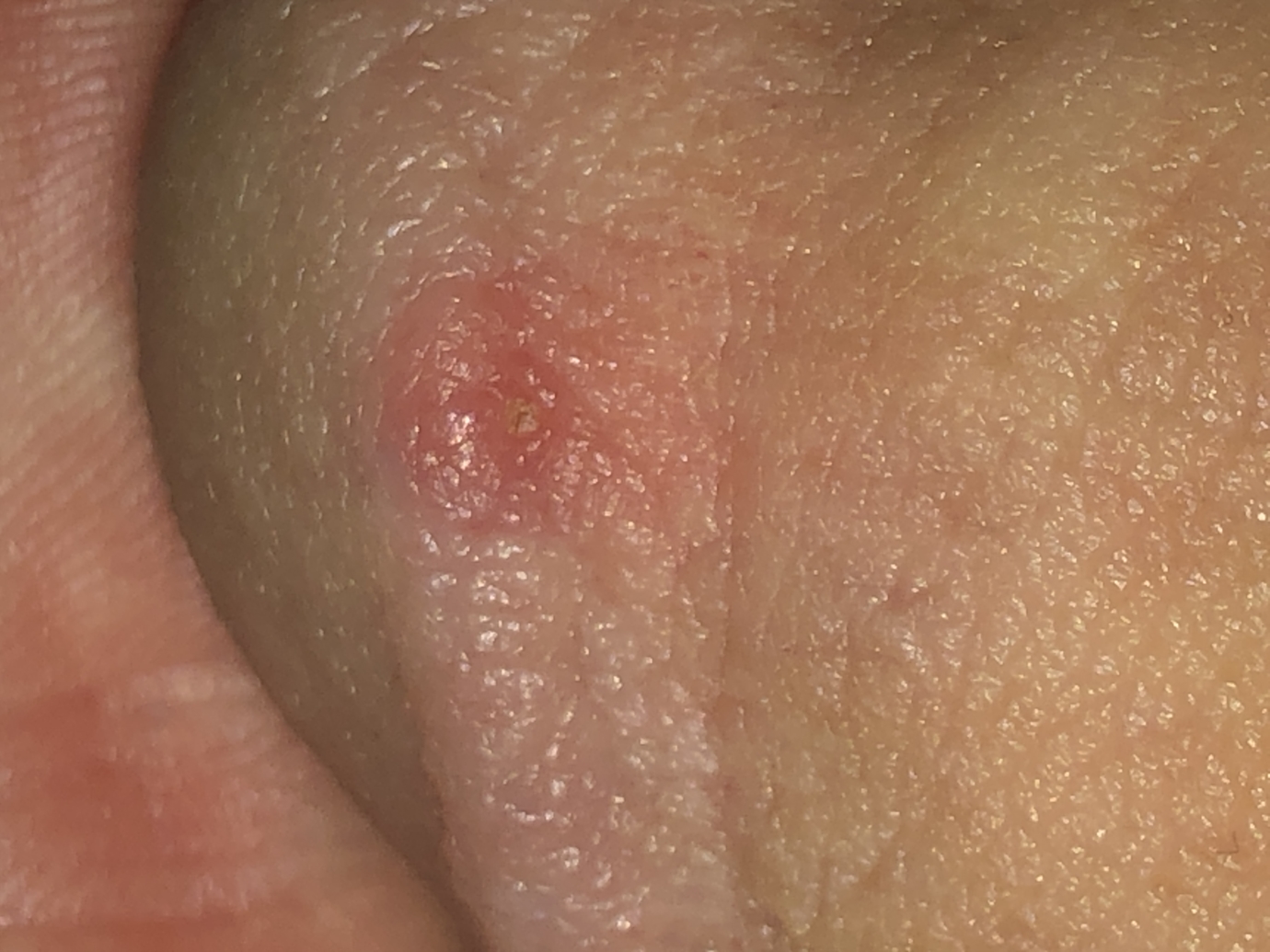 Red bump on penis head, worried it could be a STD.