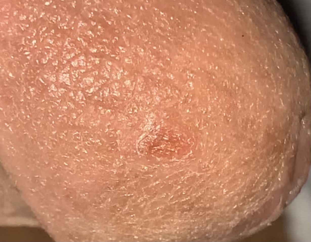 Very single red bump/spot on head of penis. | Penis Disorders | Patient