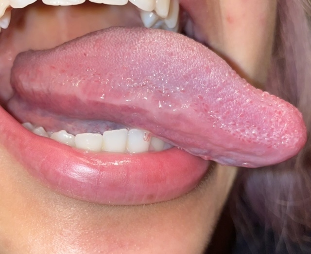 papilloma on side of tongue)
