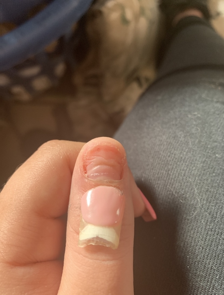 Hit my acrylic nail resulting in lifting my real nail and I believe pushing the  nail bed to skin | Nail Disorders | Forums | Patient