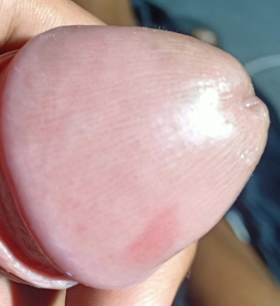 Little red spots on head of penis
