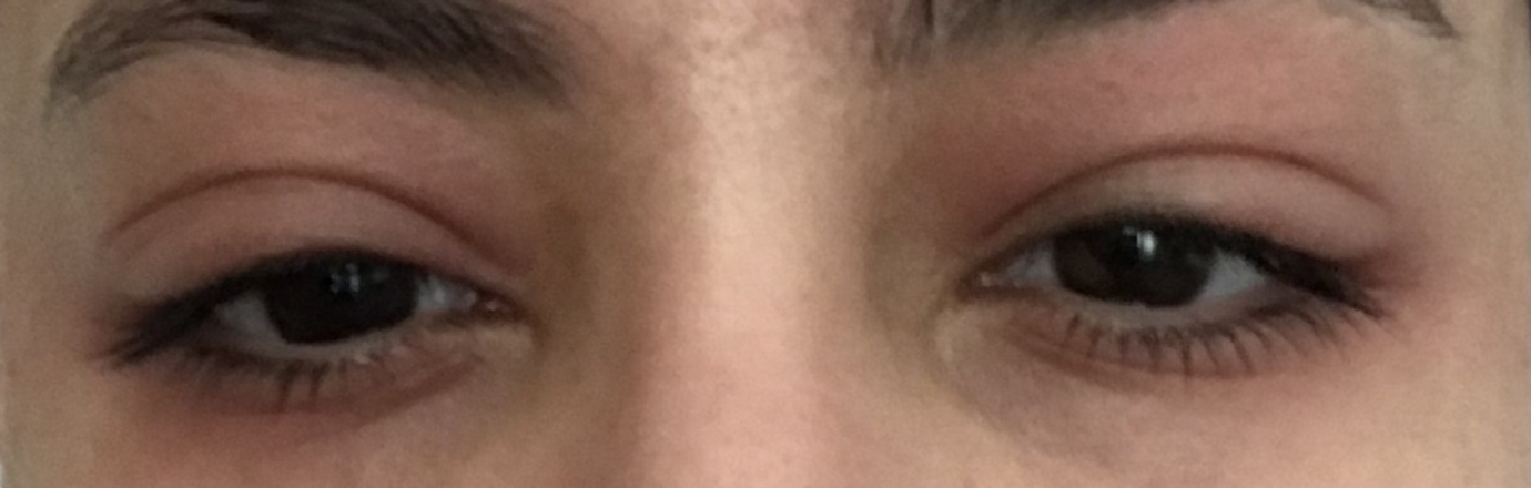 Swelling Below Brow And Eye Crease Is This Blepharitis Eye Problems 