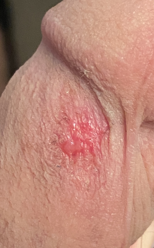 Sex from friction burn Pain After