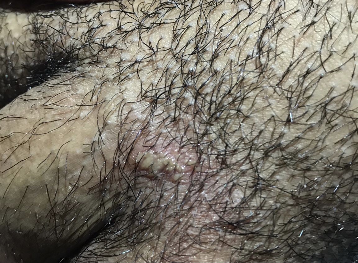Recurring rash on pubic hair ONLY for about 4 years now! | Sexual Health |  Forums | Patient