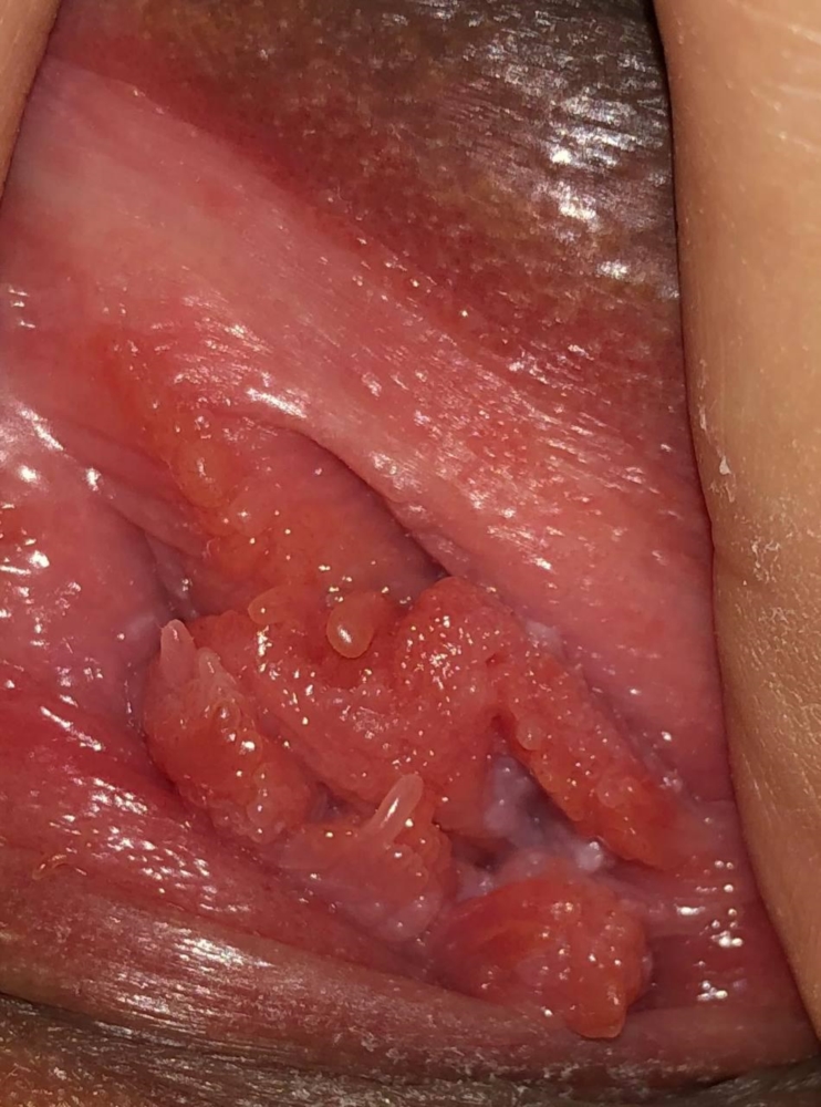 vestibular papillomatosis compared to genital warts)