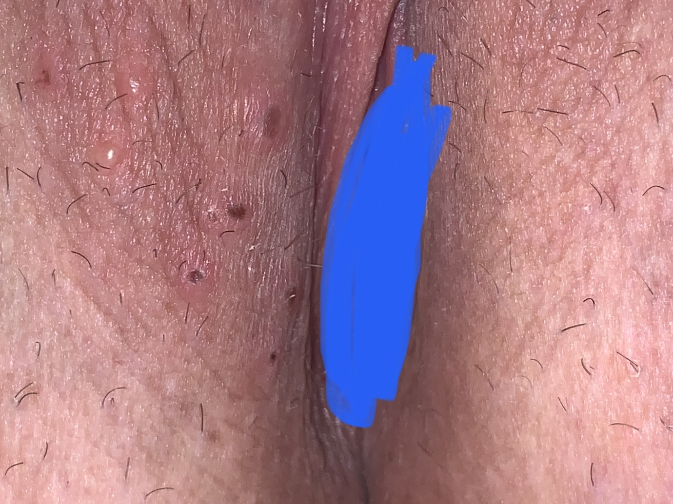 What Do You Think This Is The Bumps On My Butt Started First A