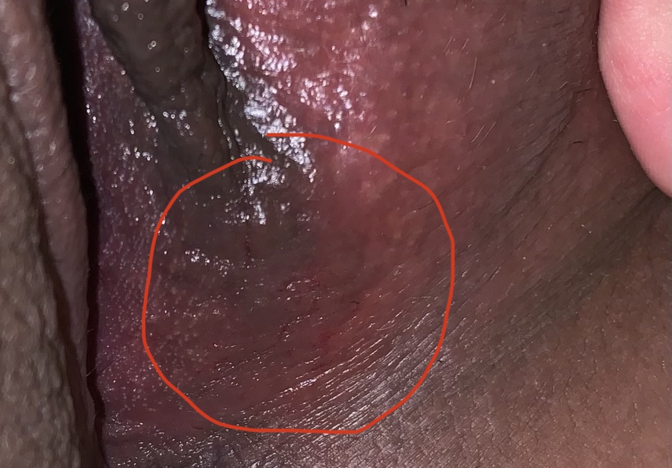 Vaginal Friction Burn