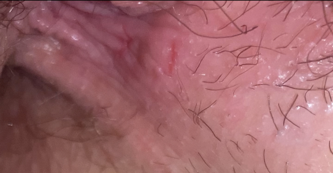 Small Cuts On Vagina