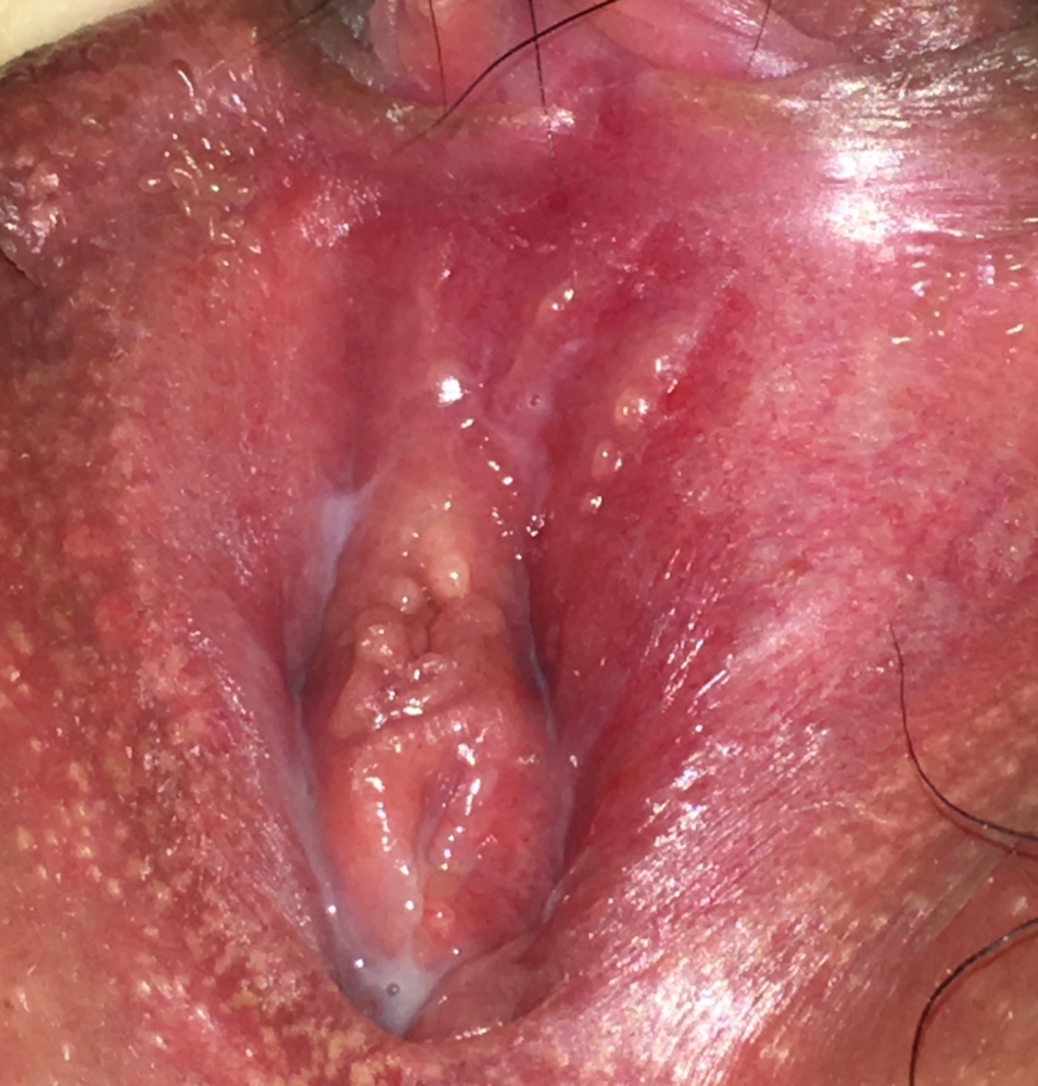 Vestibular papillomatosis on tongue, Dysbiosis treat