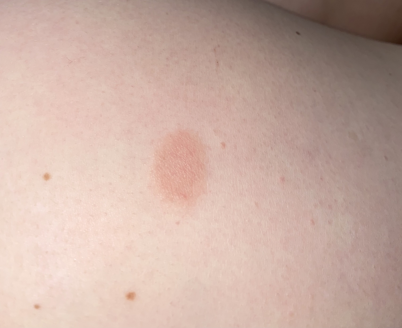 circle-rash-genital-herpes-simplex-forums-patient