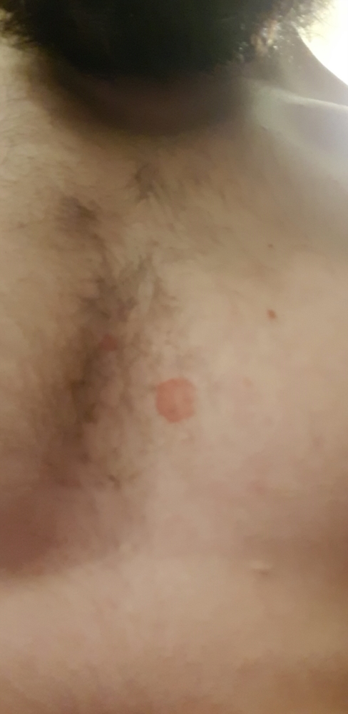 Red spot on chest (images) | Dermatology | Forums Patient