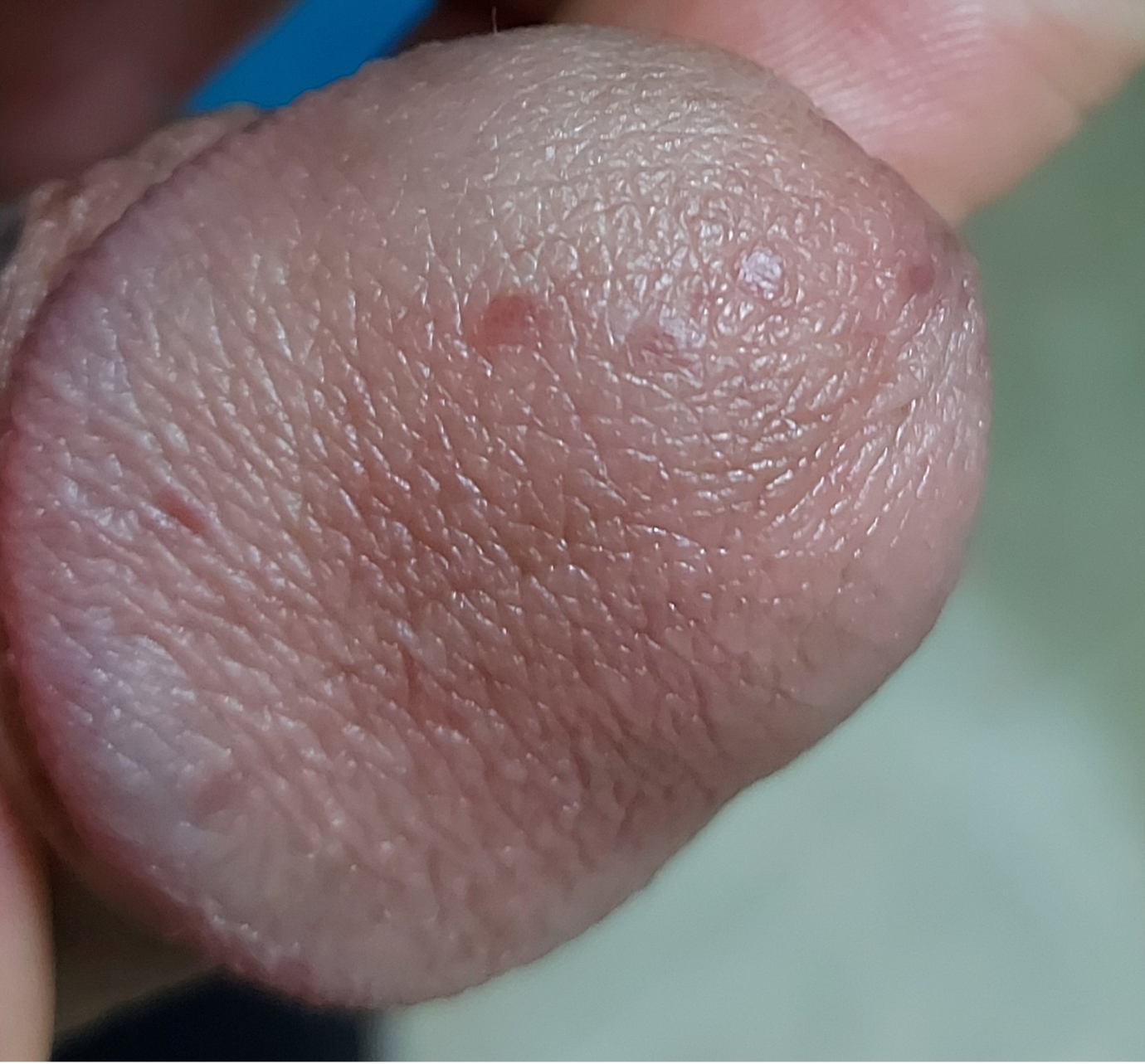 round/oval red spot on head of penis months no treatment is working; please help! Penis Disorders | | Patient