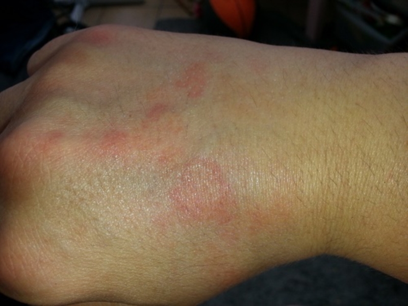 Why do i get hives on my hands and feet