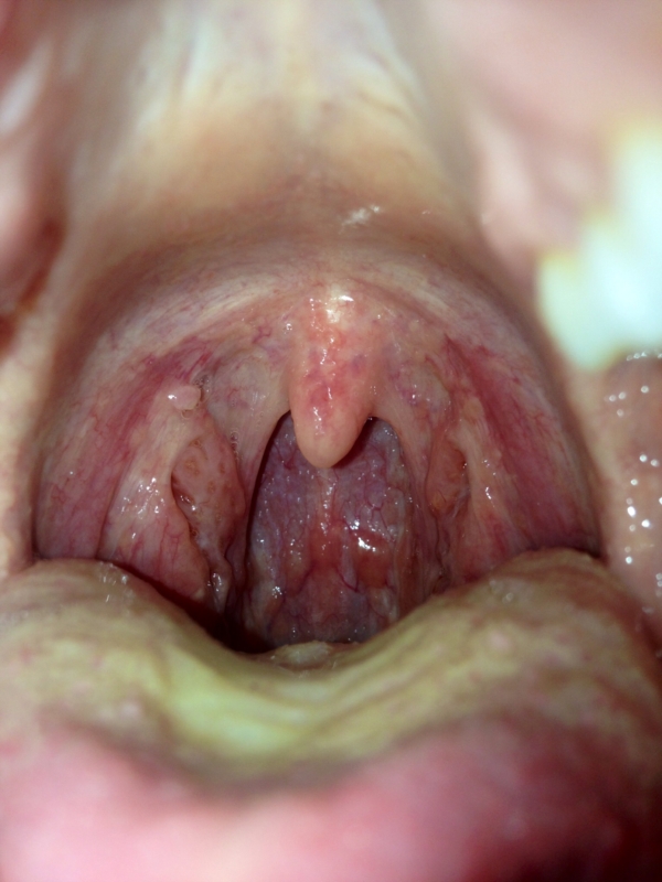 Low sperm count and epididymitis