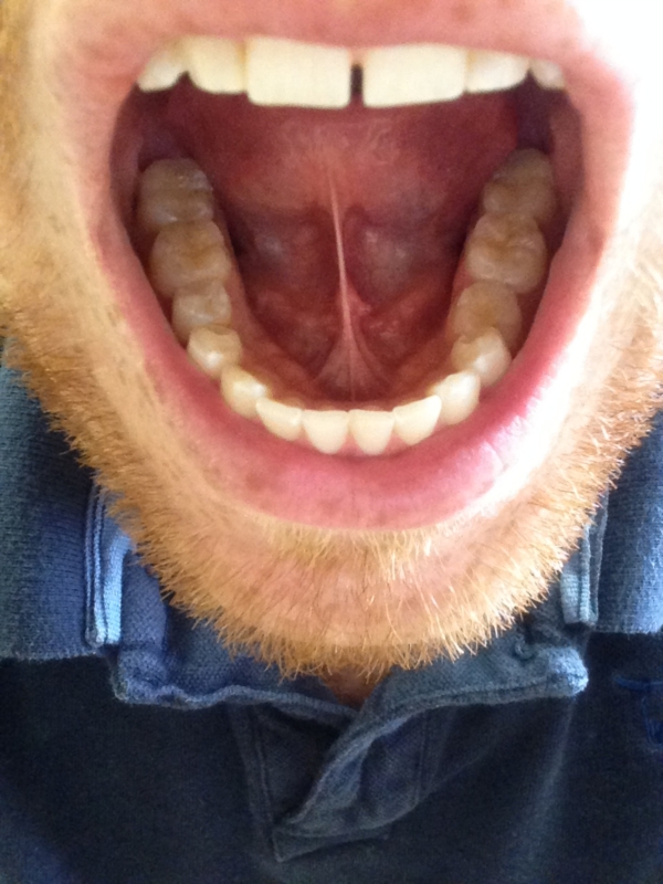 Bumps On Floor Of Mouth Salivary Gland Disorders Forums Patient